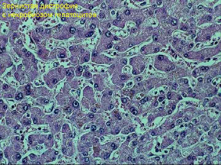 Зернистая дистрофия с некробиозом гепатоцитов 