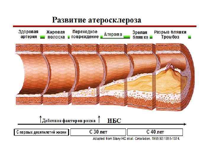 Зрелый разрыв. Жировые полоски в артериях. Особенности развития атеросклероза. Паренхиматозная перетяжка. Строение атеросклеротической бляшки.