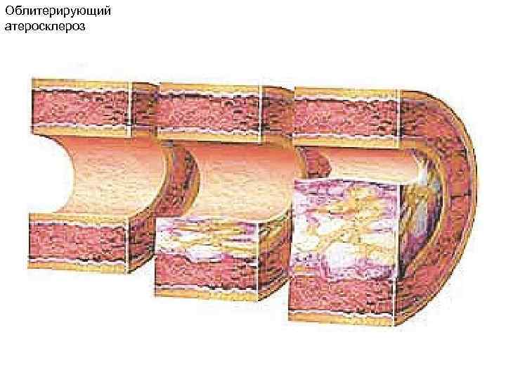 Облитерирующий атеросклероз 