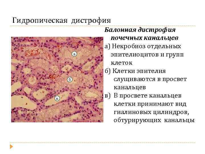 Дистрофия схема бжу