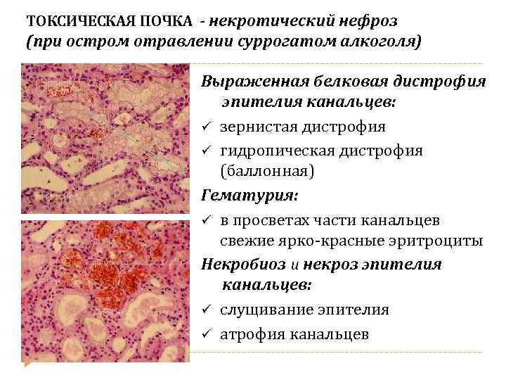 ТОКСИЧЕСКАЯ ПОЧКА - некротический нефроз (при остром отравлении суррогатом алкоголя) Выраженная белковая дистрофия эпителия