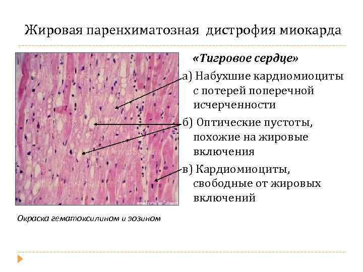 Жировая паренхиматозная дистрофия миокарда «Тигровое сердце» а) Набухшие кардиомиоциты с потерей поперечной исчерченности б)