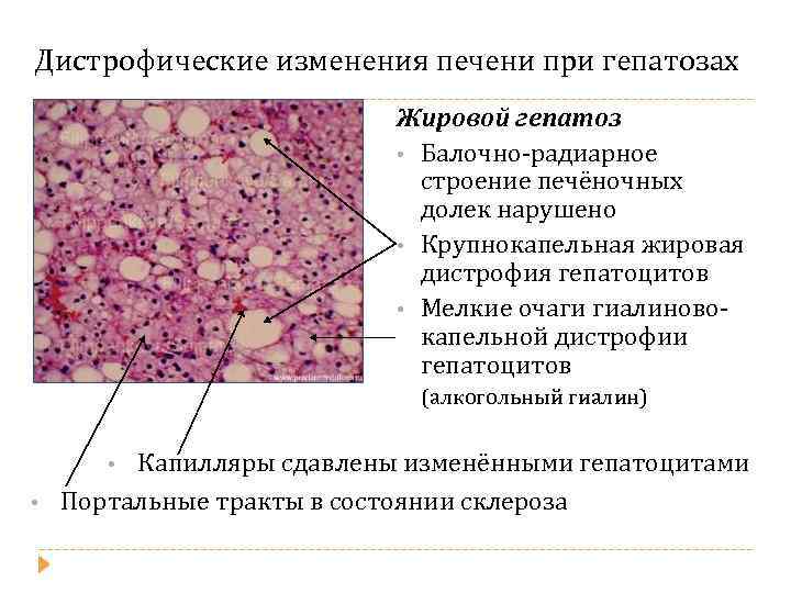 Мукоидоз дистрофия рисунок