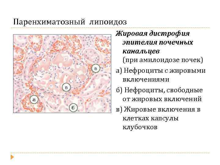Паренхиматозный липоидоз в в а б Жировая дистрофия эпителия почечных канальцев (при амилоидозе почек)