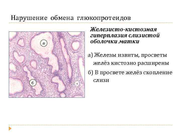 Нарушение обмена глюкопротеидов а Железисто-кистозная гиперплазия слизистой оболочки матки а) Железы извиты, просветы желёз