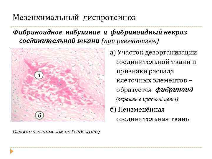 Мезенхимальный диспротеиноз Фибриноидное набухание и фибриноидный некроз соединительной ткани (при ревматизме) а а) Участок