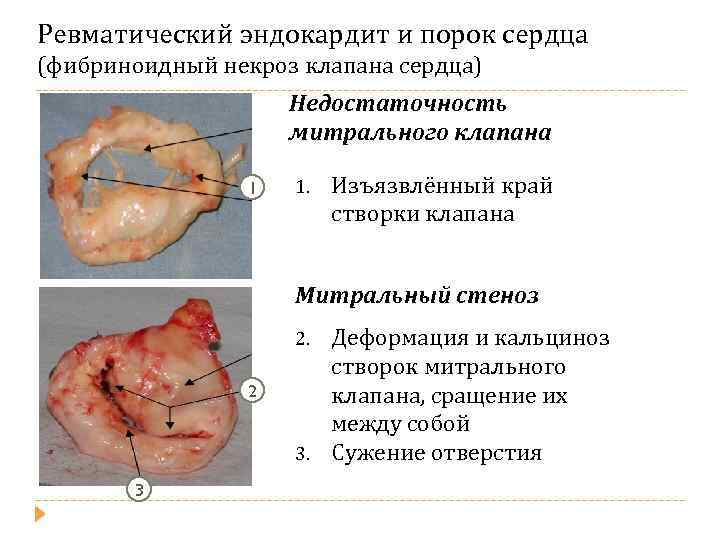 Ревматические болезни митрального клапана