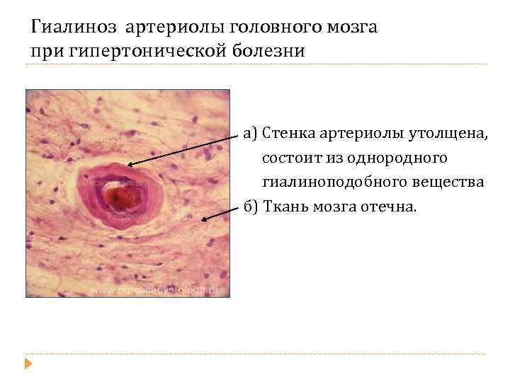Гиалиноз артериолы головного мозга при гипертонической болезни а) Стенка артериолы утолщена, состоит из однородного