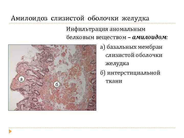 Амилоидоз слизистой оболочки желудка Инфильтрация аномальным белковым веществом – амилоидом: а) базальных мембран слизистой