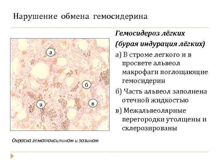 Нарушение обмена гемосидерина а б а в Окраска гематоксилином и эозином Гемосидероз лёгких (бурая