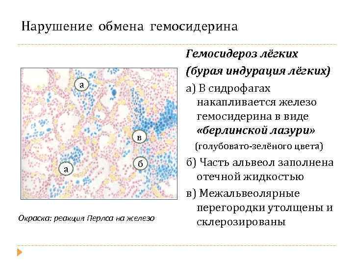 Нарушение обмена гемосидерина а в а б Окраска: реакция Перлса на железо Гемосидероз лёгких