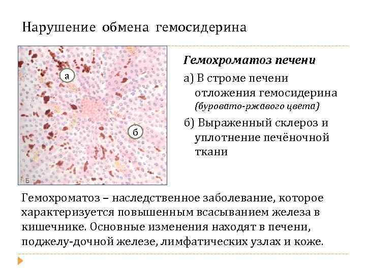 Нарушение обмена гемосидерина Гемохроматоз печени а) В строме печени отложения гемосидерина а (буровато-ржавого цвета)