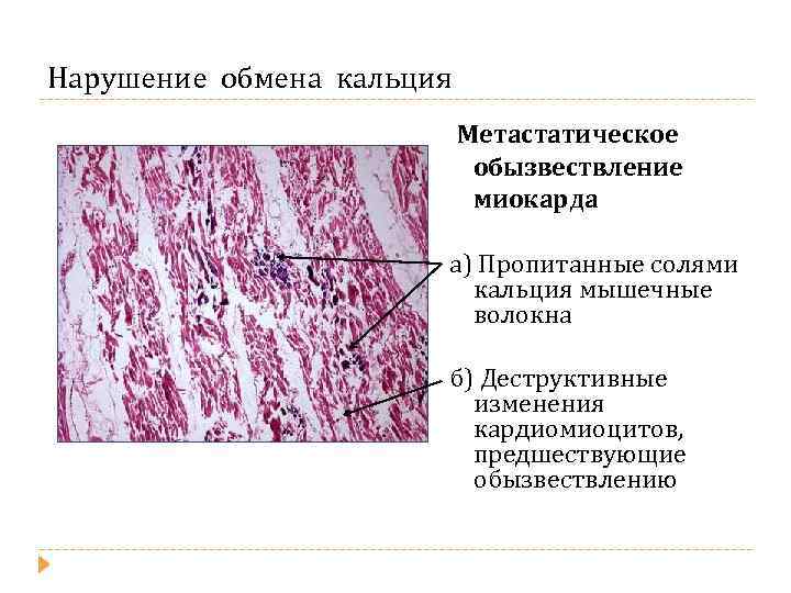Нарушение обмена кальция Метастатическое обызвествление миокарда а) Пропитанные солями кальция мышечные волокна б) Деструктивные