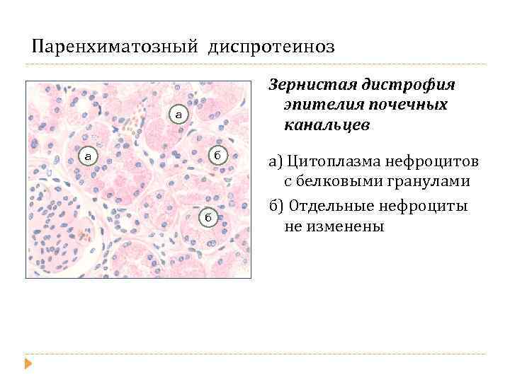 Паренхиматозный диспротеиноз Зернистая дистрофия эпителия почечных канальцев а б а) Цитоплазма нефроцитов с белковыми