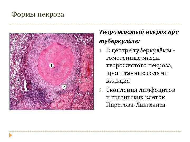 Формы некроза 1 2 Творожистый некроз при туберкулёзе: 1. В центре туберкулёмы гомогенные массы