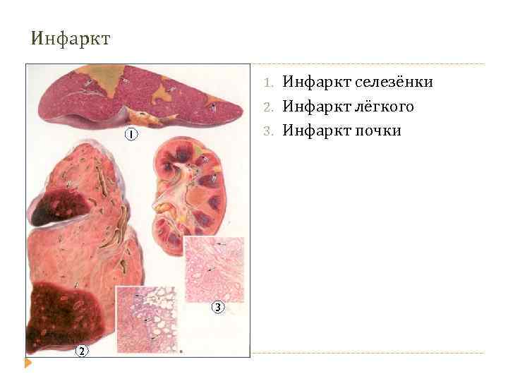 Инфаркт 1. 2. 3. 1 3 2 Инфаркт селезёнки Инфаркт лёгкого Инфаркт почки 