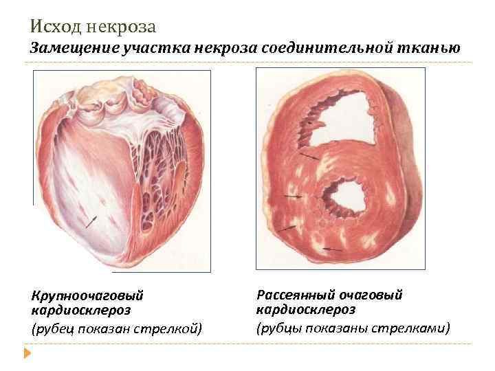 Исход некроза Замещение участка некроза соединительной тканью Крупноочаговый кардиосклероз (рубец показан стрелкой) Рассеянный очаговый