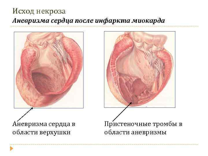 Исход некроза Аневризма сердца после инфаркта миокарда Аневризма сердца в области верхушки Пристеночные тромбы