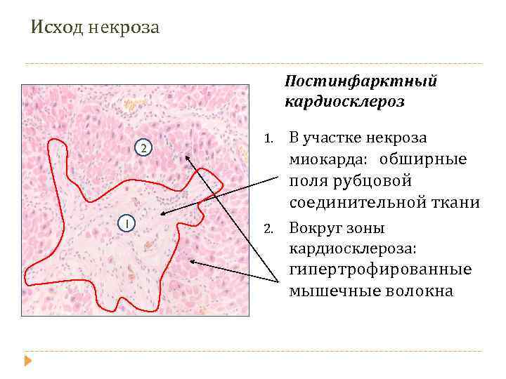 Постинфарктный кардиосклероз карта вызова скорой