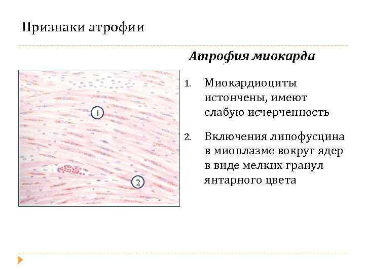 Признаки атрофии Атрофия миокарда 1. Миокардиоциты истончены, имеют слабую исчерченность 2. Включения липофусцина в