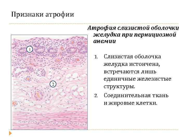 Слизистая атрофична. Атрофия слизистой желудка микропрепарат. Микропрепарат атрофия слизистой оболочки желудка. Атрофия слизистой желудка при пернициозной анемии. Атрофический гастрит патанатомия.
