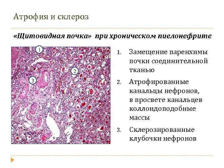 Диффузная паренхима почек. Хронический пиелонефрит патанатомия. Хронический пиелонефрит патанатомия микропрепарат. Пиелонефрит препарат патанатомия. Щитовидная почка патанатомия.