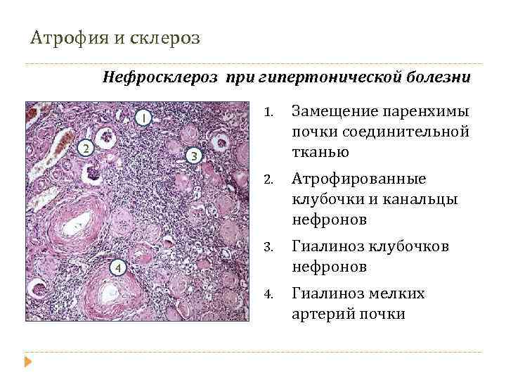 Артериолосклеротический нефросклероз микропрепарат рисунок