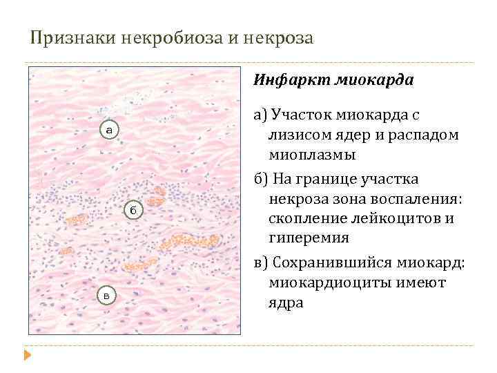 Признаки некробиоза и некроза Инфаркт миокарда а б в а) Участок миокарда с лизисом