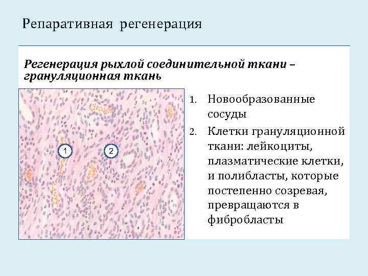 Репаративная регенерация Регенерация рыхлой соединительной ткани – грануляционная ткань Новообразованные сосуды 2. Клетки грануляционной