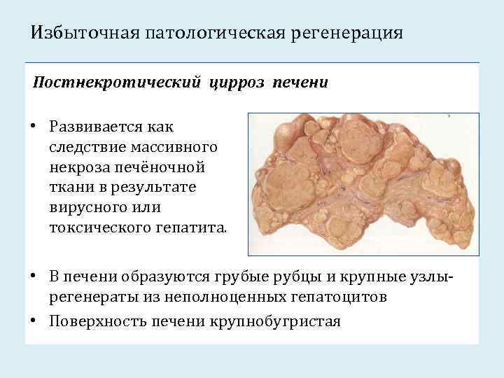 Избыточная патологическая регенерация Постнекротический цирроз печени • Развивается как следствие массивного некроза печёночной ткани