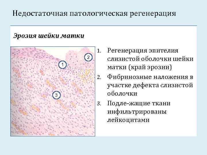 Недостаточная патологическая регенерация Эрозия шейки матки Регенерация эпителия слизистой оболочки шейки матки (край эрозии)