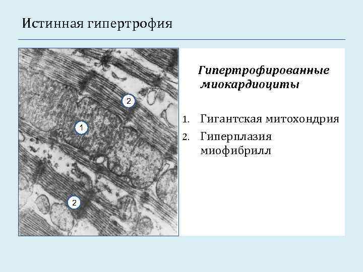 Истинная гипертрофия Гипертрофированные миокардиоциты 2 1 2 Гигантская митохондрия 2. Гиперплазия миофибрилл 1. 