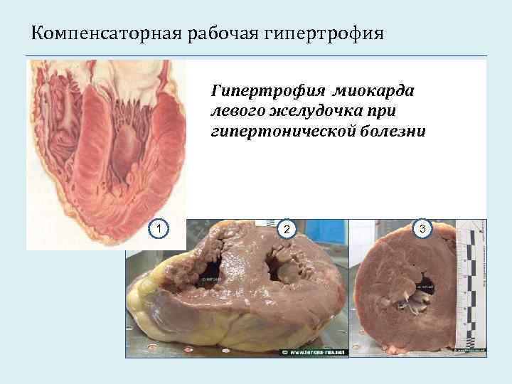 Компенсаторная рабочая гипертрофия Гипертрофия миокарда левого желудочка при гипертонической болезни 1 2 3 