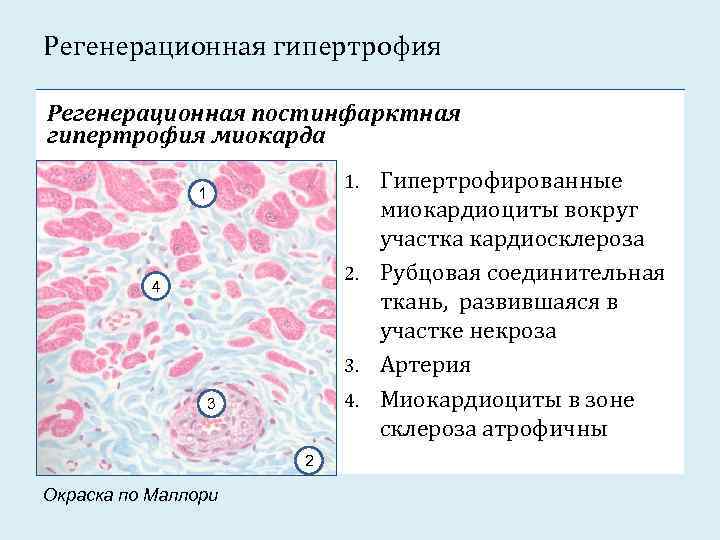 Гипертрофия клитора фото