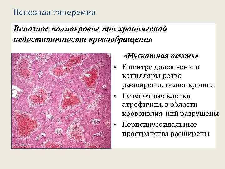 Венозная гиперемия Венозное полнокровие при хронической недостаточности кровообращения 2 1 1 2 1 «Мускатная