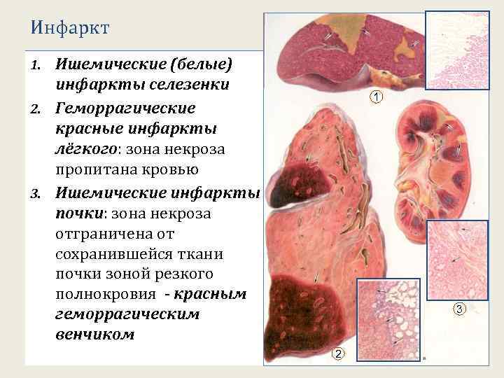 Инфаркт Ишемические (белые) инфаркты селезенки 2. Геморрагические красные инфаркты лёгкого: зона некроза пропитана кровью