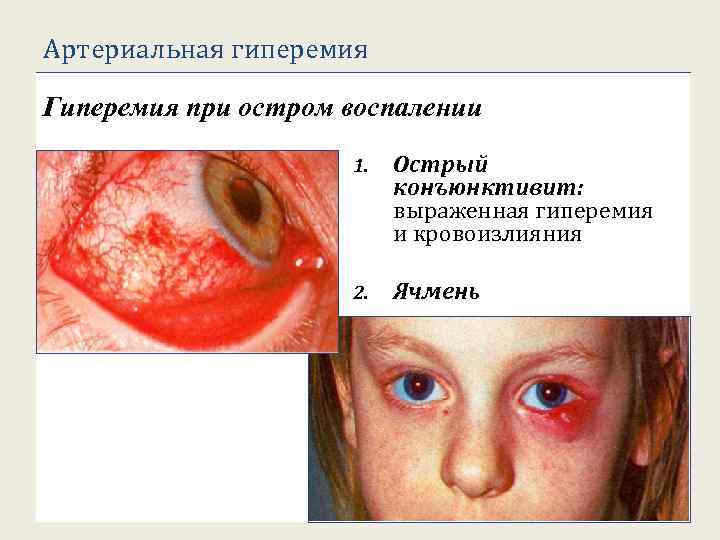 Артериальная гиперемия Гиперемия при остром воспалении 1. Острый конъюнктивит: выраженная гиперемия и кровоизлияния 2.