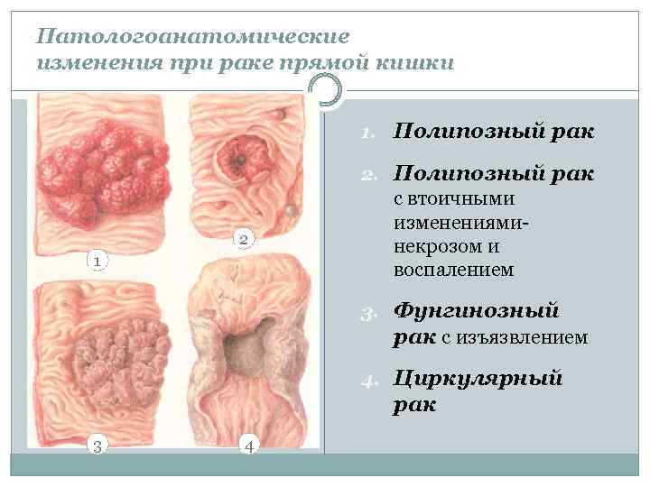 Патологоанатомические изменения при раке прямой кишки 1. Полипозный рак 2 1 с втоичными измененияминекрозом