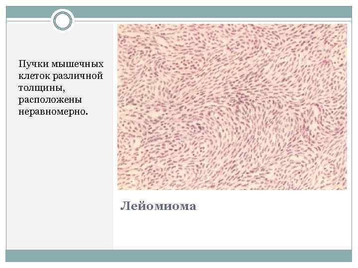 Пучки мышечных клеток различной толщины, расположены неравномерно. Лейомиома 