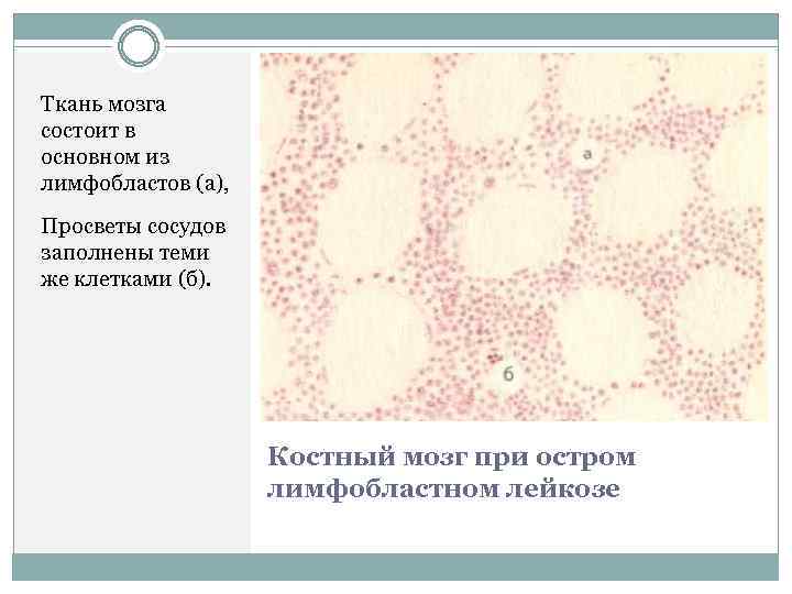 Ткань мозга состоит в основном из лимфобластов (а), Просветы сосудов заполнены теми же клетками
