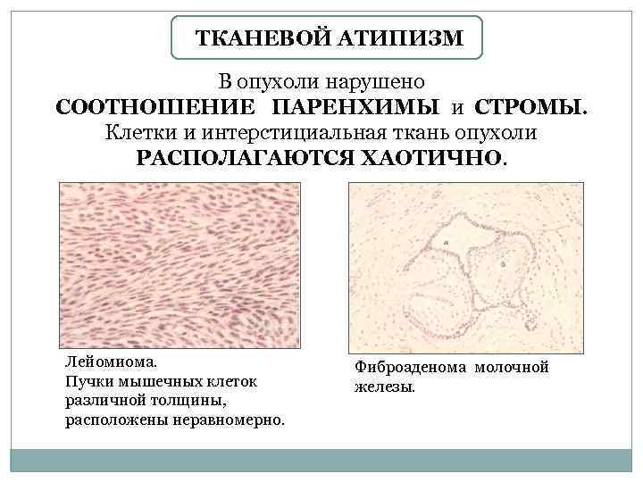 ТКАНЕВОЙ АТИПИЗМ В опухоли нарушено СООТНОШЕНИЕ ПАРЕНХИМЫ и СТРОМЫ. Клетки и интерстициальная ткань опухоли