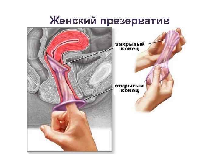 Женский презерватив 