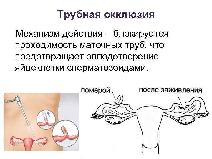 Трубная окклюзия Механизм действия – блокируется проходимость маточных труб, что предотвращает оплодотворение яйцеклетки сперматозоидами.