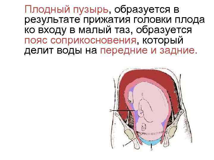 Плодный пузырь, образуется в результате прижатия головки плода ко входу в малый таз, образуется