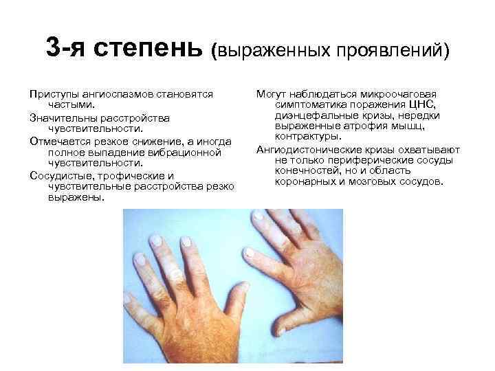 3 -я степень (выраженных проявлений) Приступы ангиоспазмов становятся частыми. Значительны расстройства чувствительности. Отмечается резкое