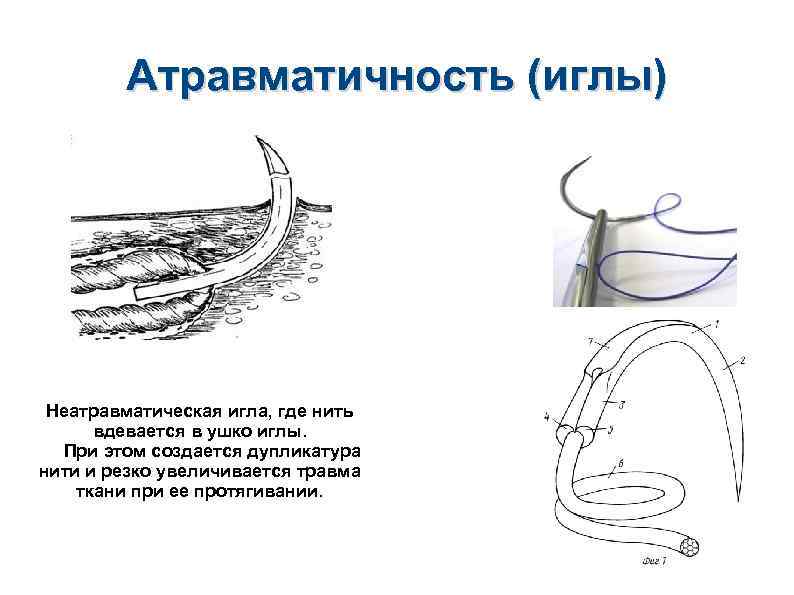 Атравматичность (иглы) Неатравматическая игла, где нить вдевается в ушко иглы. При этом создается дупликатура