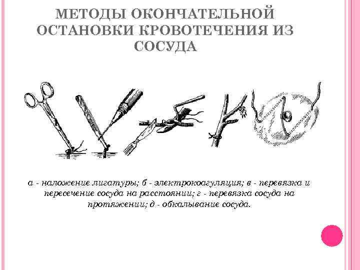 МЕТОДЫ ОКОНЧАТЕЛЬНОЙ ОСТАНОВКИ КРОВОТЕЧЕНИЯ ИЗ СОСУДА а - наложение лигатуры; б - электрокоагуляция; в