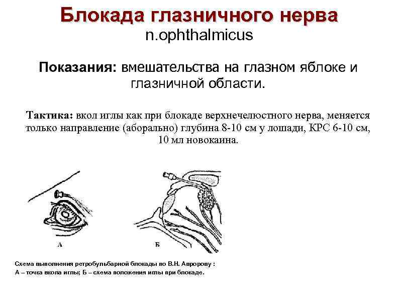 Блокада глазничного нерва n. ophthalmicus Показания: вмешательства на глазном яблоке и глазничной области. Тактика: