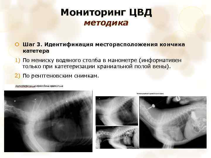 Мониторинг ЦВД методика Шаг 3. Идентификация месторасположения кончика катетера 1) По мениску водяного столба