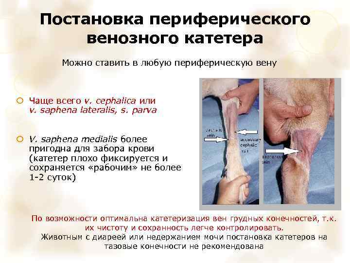 Постановка периферического венозного катетера Можно ставить в любую периферическую вену Чаще всего v. cephalica